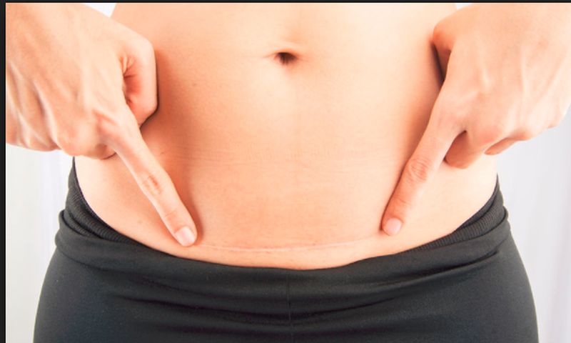 Όλα όσα πρέπει να γνωρίζετε για την καισαρική