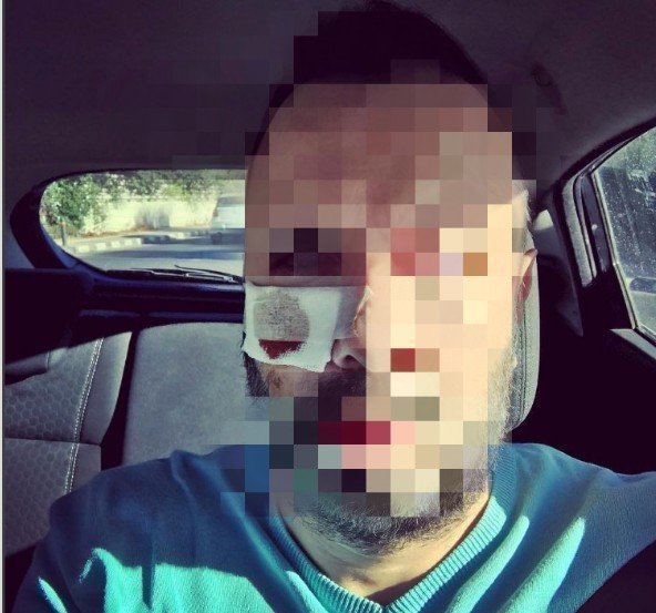 Πριν απο λίγο: Ατύχημα-σοκ για Κύπριο παρουσιαστή Εσπεσυμένα σε κλινική για ράμματα στο πρόσωπο!!