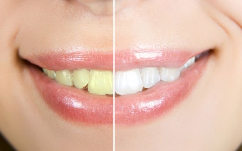 4 tips για λευκά δόντια