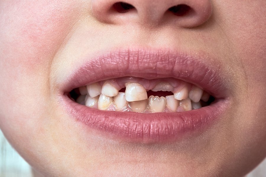 Γιατί τα δόντια του μωρού μεγαλώνουν στραβά;