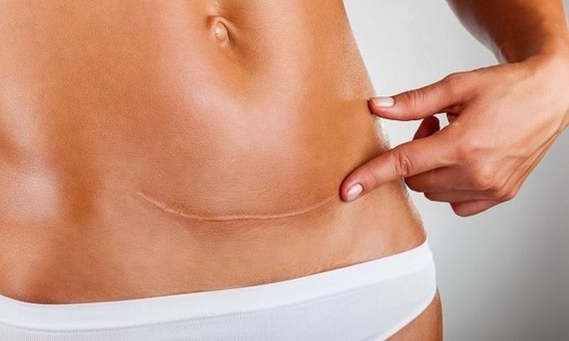 VIDEO: Πώς θα αναρρώσεις μετά την καισαρική τομή