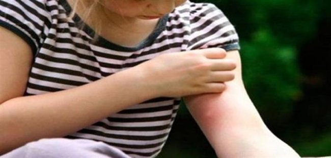 Αυτά πρέπει να ξέρετε αν το παιδί σας είναι αλλεργικό στις σφήκες ή τις μέλισσες