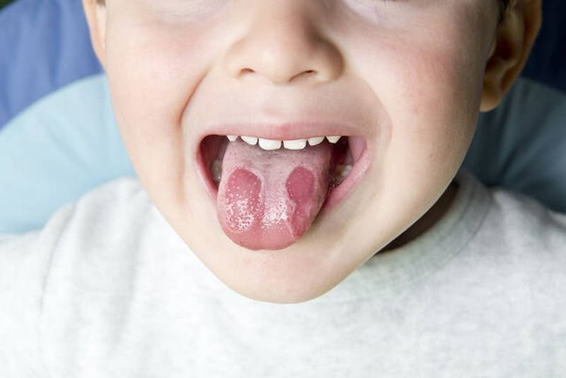 Όσα πρέπει να γνωρίζετε για την παιδική στοματίτιδα